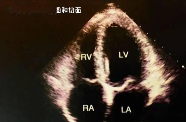 成人心脏彩超教学视频,成人心脏检查要点解析